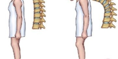 D Vitamini Kanser Oluşumuna Karşı Büyük Önem Taşıyor