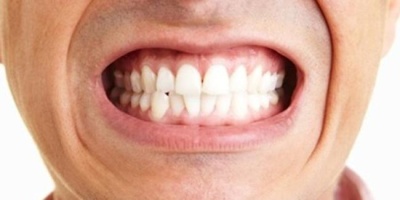 Diş Sıkmanın Zararları