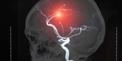 Hiç duymadığınız Karotis darlığı nedir?