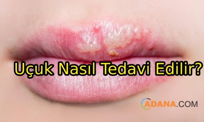 Uçuk Nasıl Tedavi Edilir?