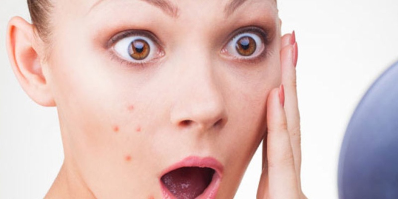 Diş Macunu Sivilcelere İyi Gelir mi?