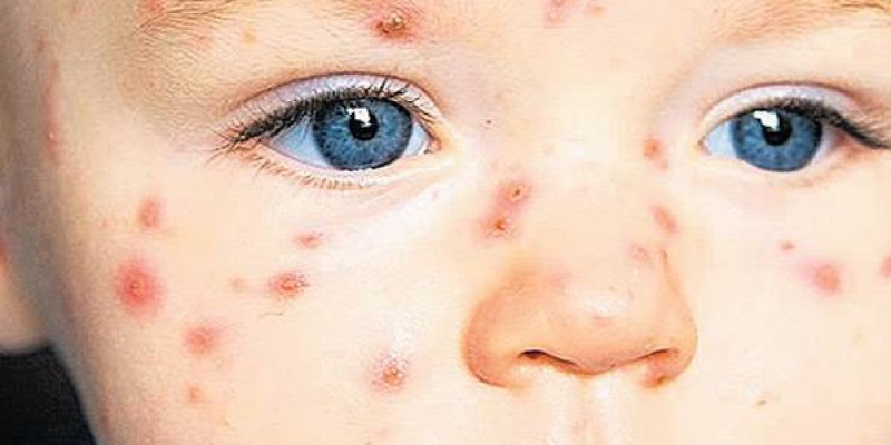 Su Çiçeği (Çiçek Hastalığı) Belirtileri Ve Tedavisi