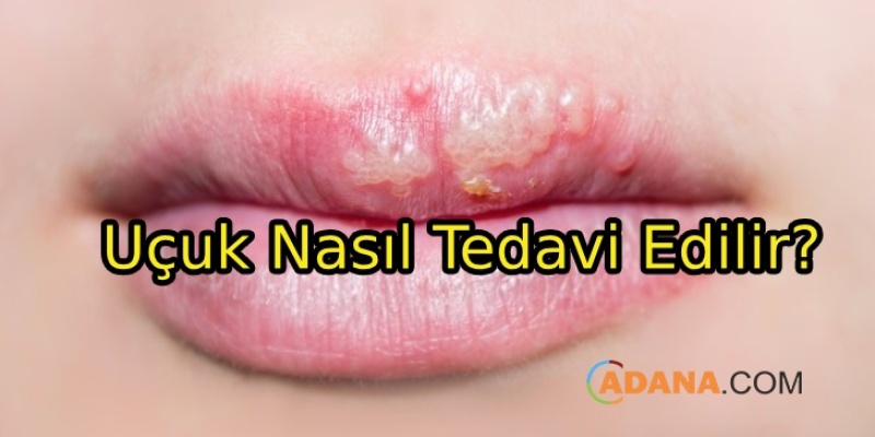 Uçuk Nasıl Tedavi Edilir?