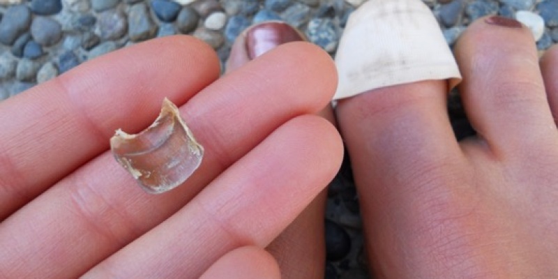 Tırnak Düşmesi Neden Olur?